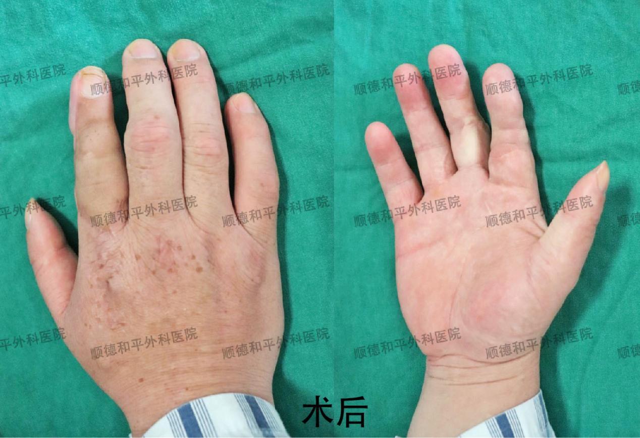 新疆患者失去手指心生自卑，遠赴廣東手指再造＿手外科醫(yī)院咨詢(圖2)