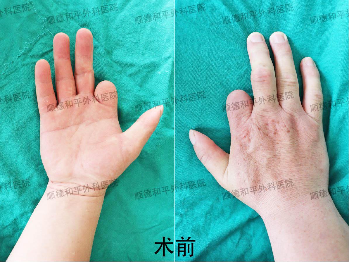 新疆患者失去手指心生自卑，遠赴廣東手指再造＿手外科醫(yī)院咨詢(圖1)
